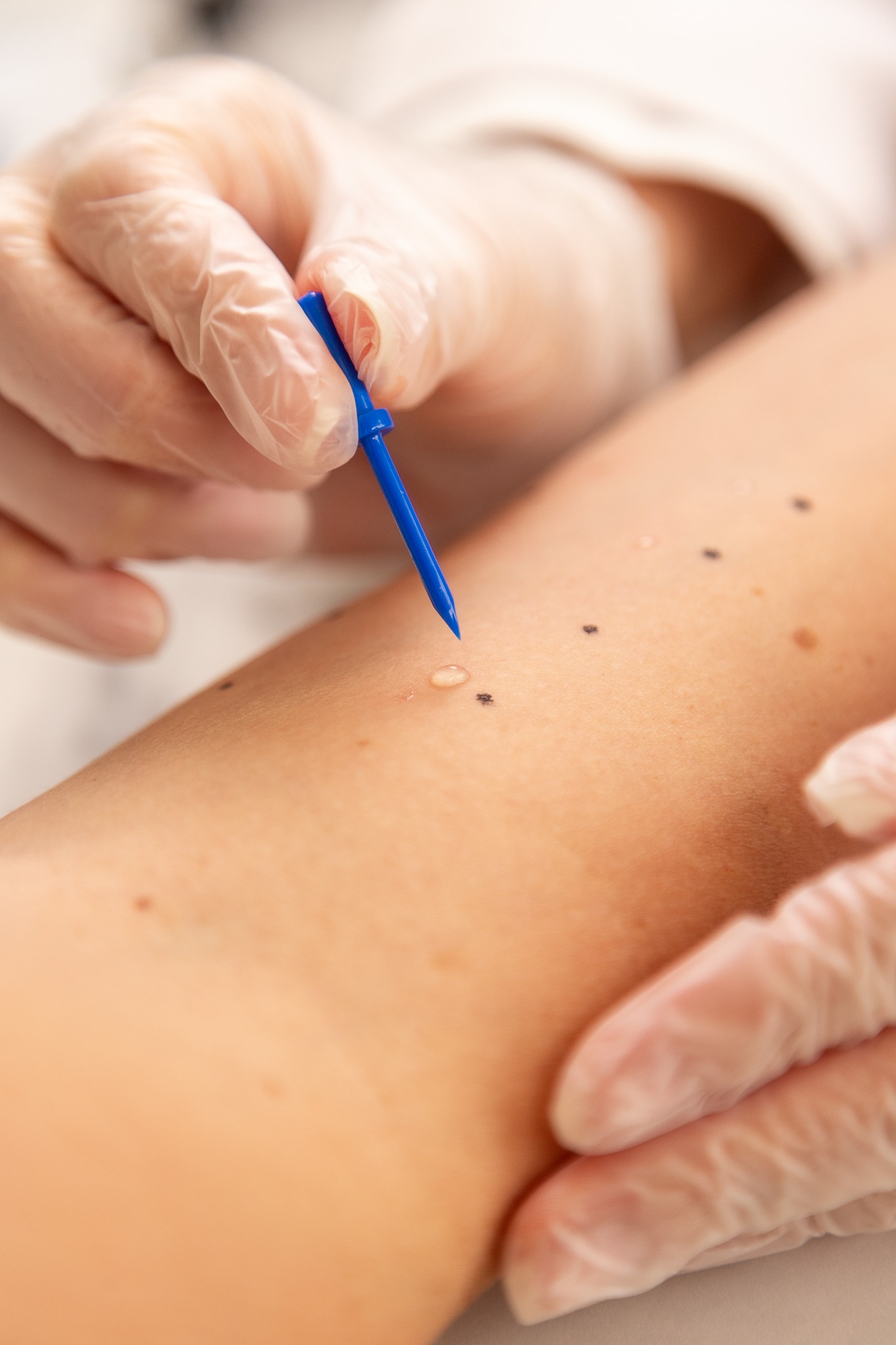 Prick-test na pele do braço